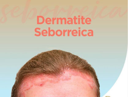 Você sofre com Dermatite Seborreica?