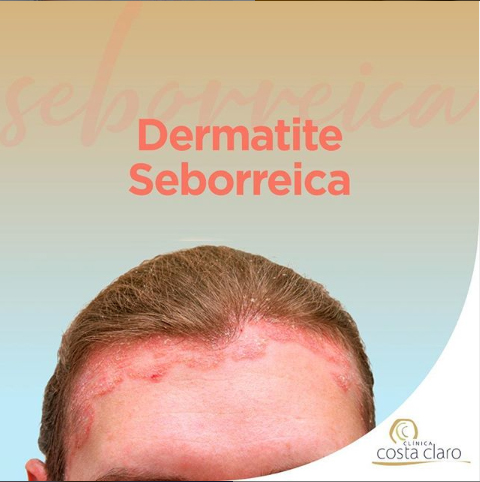 Você sofre com Dermatite Seborreica?